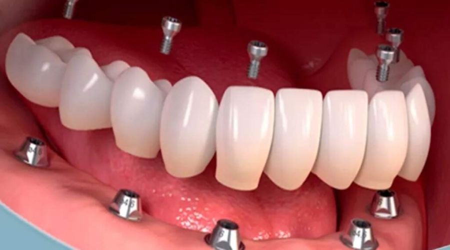 Imagem de Implante Dentário